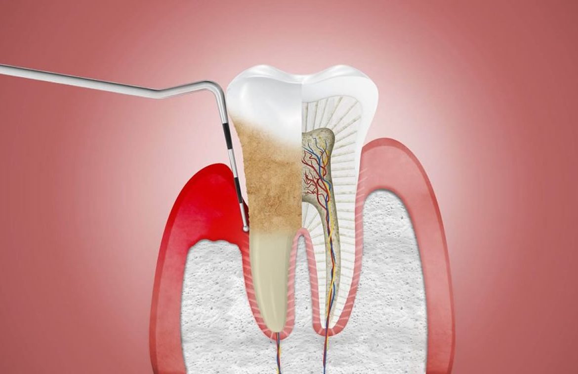 Periodoncia